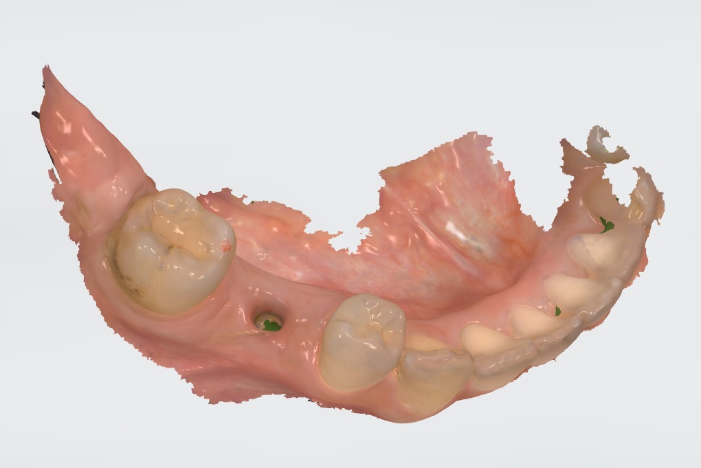 インプラント治療例口腔内スキャナー画像
