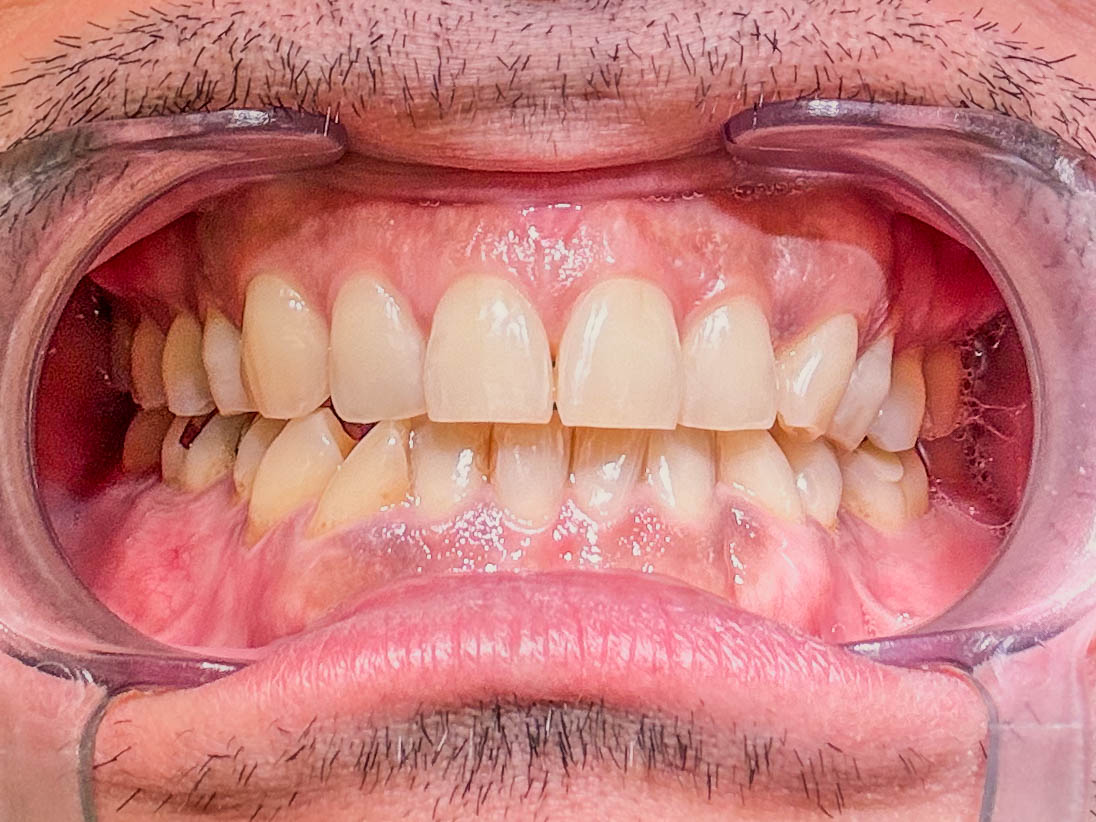 歯茎のメラニン除去